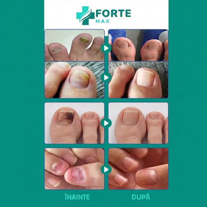Plasturi Reparare Unghii Picioare